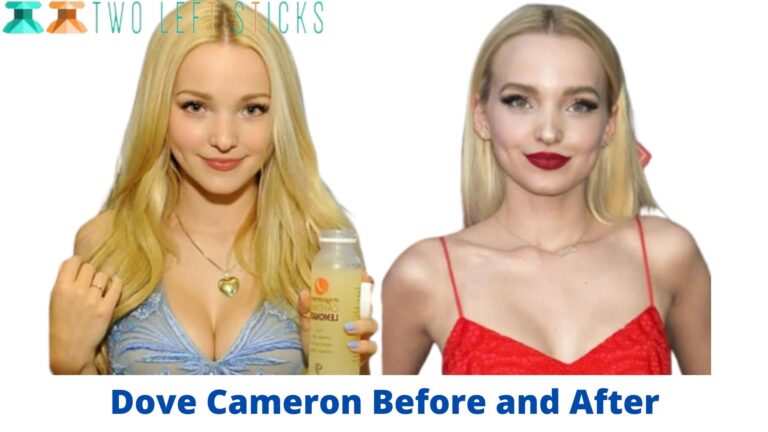 Dove Cameron Before and After- She hasn’t had any Plastic Surgery?