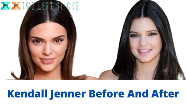 Kendall Jenner Before And After- But Has She Undergone Surgery?