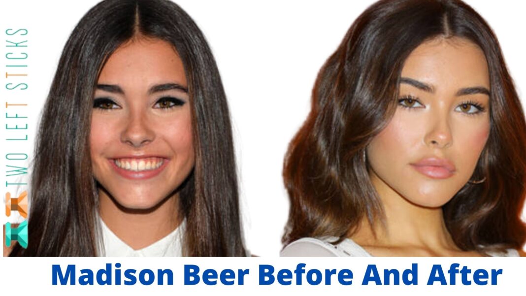 Madison Beer Before And After Did She Get Plastic Surgery