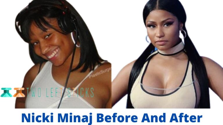 Nicki Minaj Before And After- She Underwent Plastic Surgery and received Butt Implants.